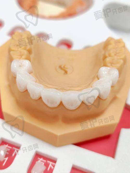 西安中诺口腔做爱尔创全瓷牙冠1380元起，品质优良助您绽放自信笑容 