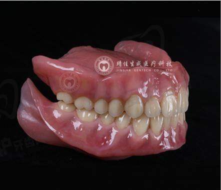 福州维乐口腔BPS吸附性义齿价格为何11800元起？