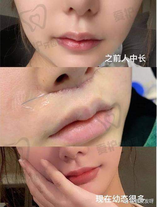人中窝加深项目适合哪些人群？