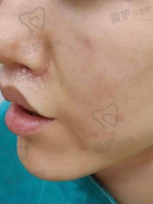 什么是无痕人中缩短术？