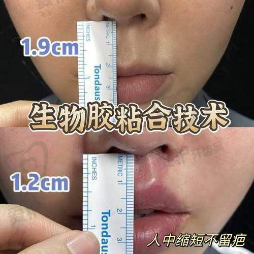 什么是人中缩短项目？