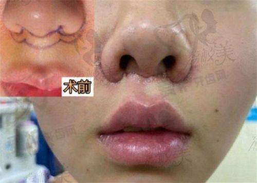 无痕人中缩短术的成效能维持多久？