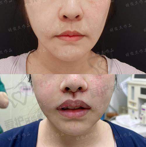 人中缩短手术的修复过程是怎样的？