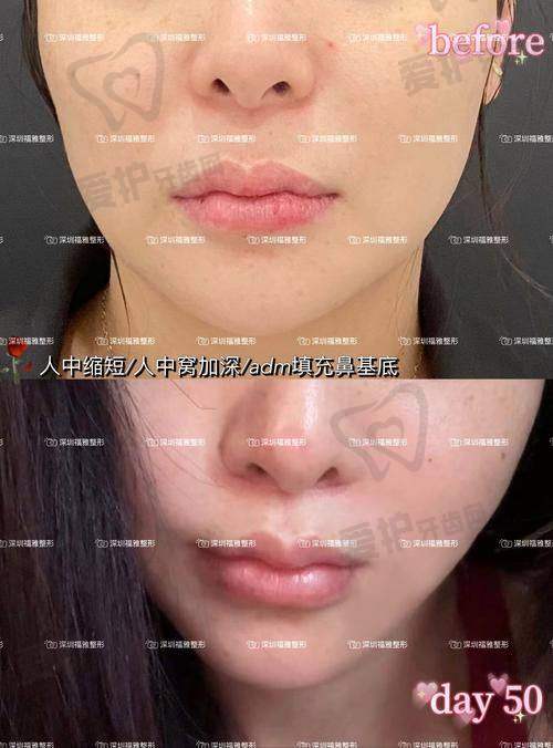 如何选择适合自己的人中窝加深方案？