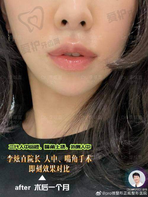 术后有哪些注意事项？