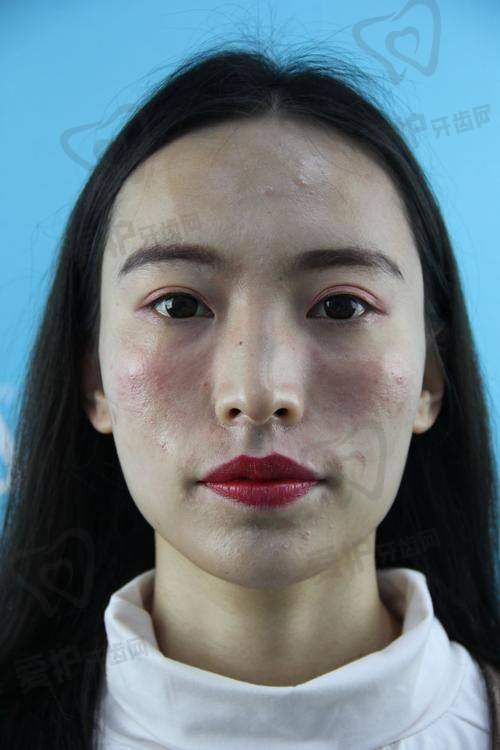 为什么选择北京三仁伊光进行玻尿酸填充？