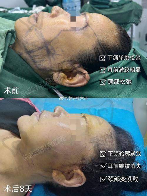 拉皮手术的缺点——修复时间长，存在一定风险