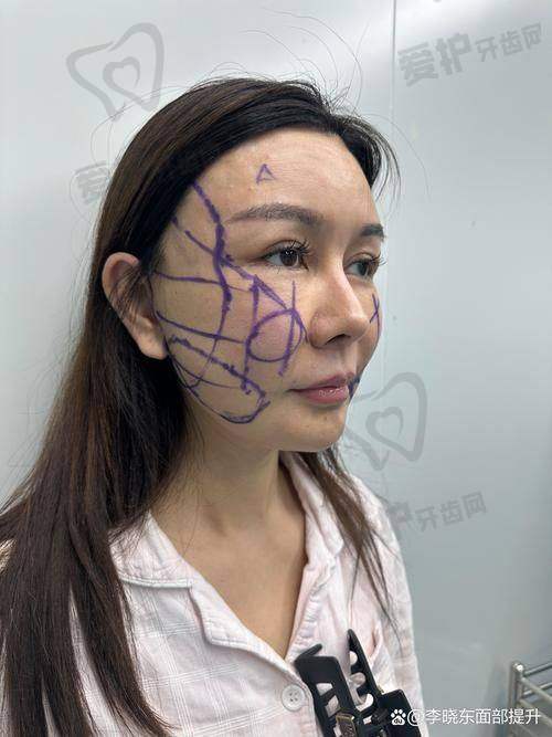 真人十年对比照——拉皮手术成效的直观呈现