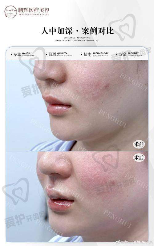 人中窝加深项目与其他面部整形项目有什么关联？