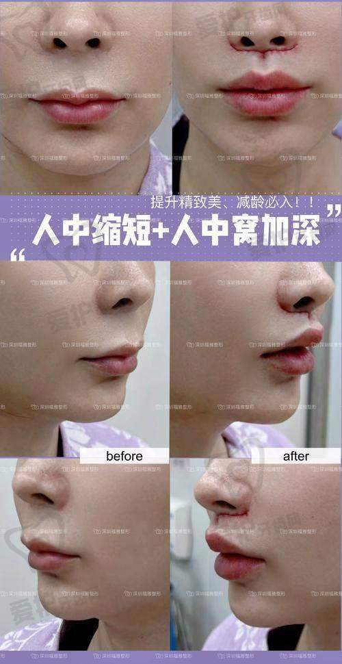人中窝加深项目能带来怎样的成效？