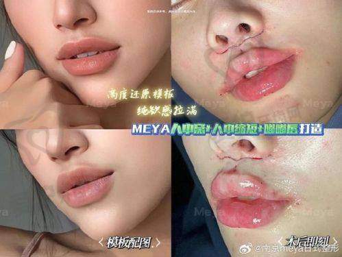 人中窝加深项目的手术过程是怎样的？