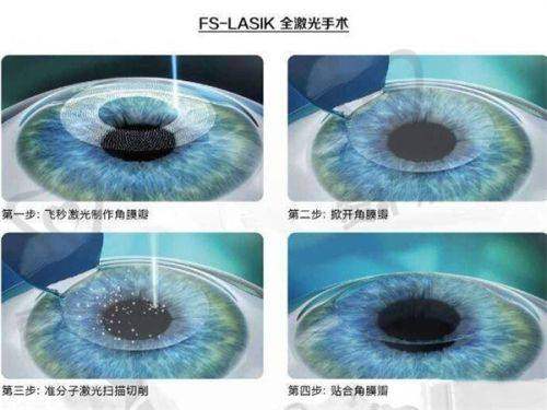 精细化雕刻飞秒手术的价格分阶体现是怎样的?