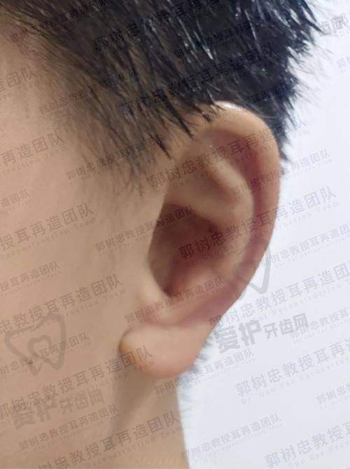 耳再造整形手术后需要注意什么？