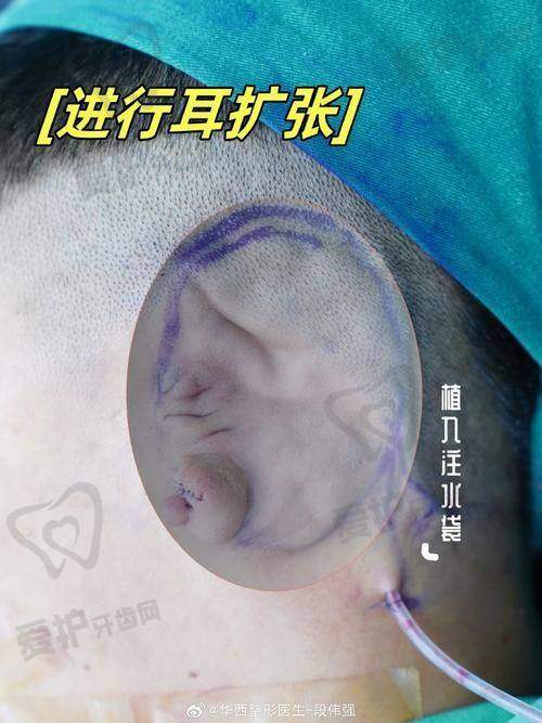 如何预约成都八大处章庆国医生的耳再造整形手术？