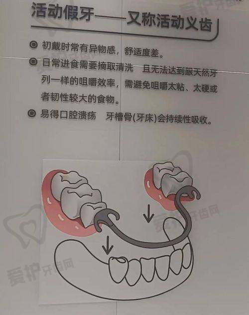 福州维乐口腔医院全口假牙的售后保护如何？