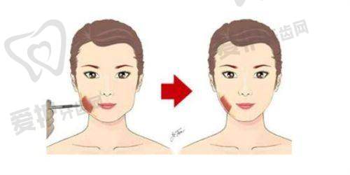 双眼皮项目介绍