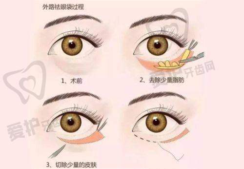 下颌骨截骨相关科普