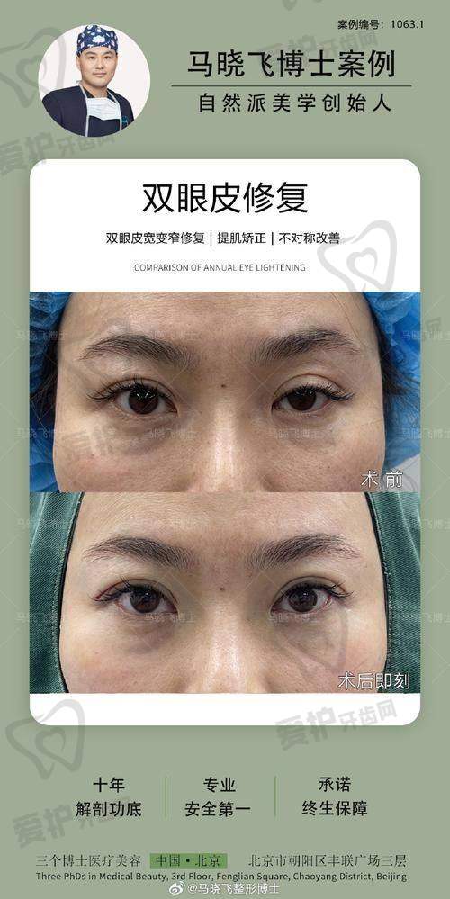 去眼袋手术项目揭秘