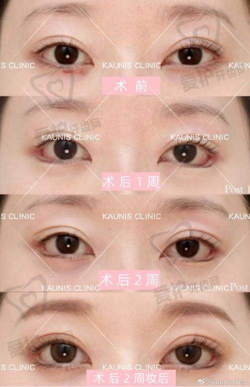 上海时光有哪些成功的双眼皮实例？