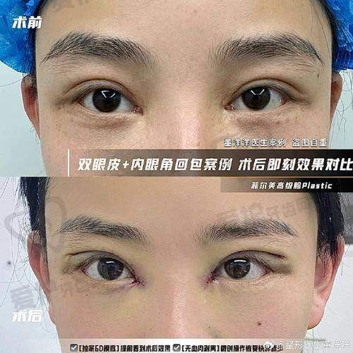 上海时光的医生团队在双眼皮手术方面有怎样的经验和资质？