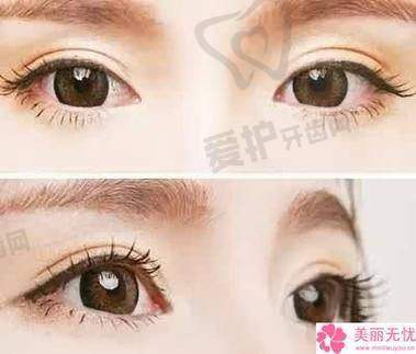 上海时光医院的双眼皮整形技术有哪些？