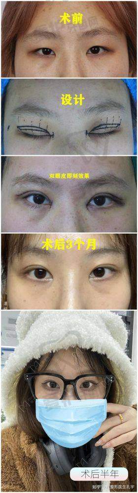 选择上海时光医院张嘉林医生进行双眼皮整形有哪些优势？