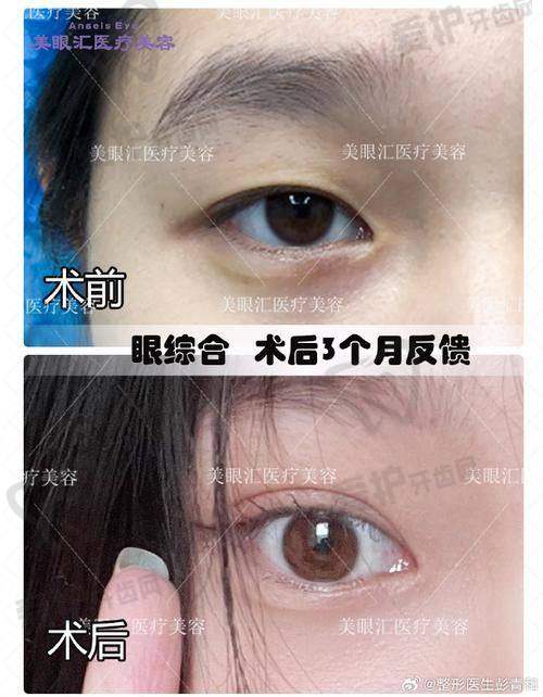患者对上海时光医院张嘉林医生的双眼皮整形成效评价如何？