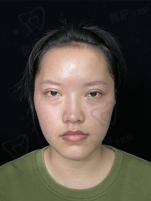双眼皮修复手术的流程是怎样的？