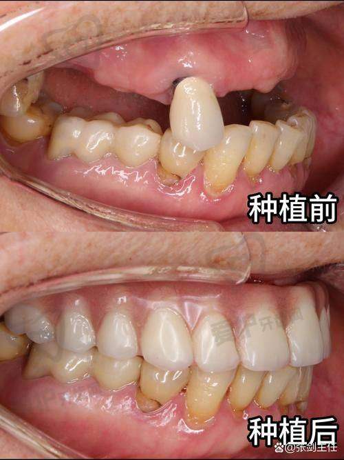 美国皓圣种植牙有什么特点？