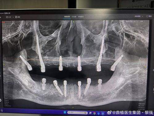 选择北京劲松口腔汪晓晖医生做穿颧穿翼半口种植牙有哪些保护？
