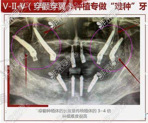 什么是穿颧穿翼半口种植牙？