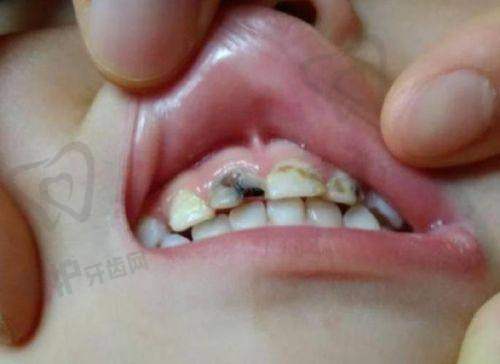窝沟封闭和涂氟对预防儿童龋齿有什么作用？
