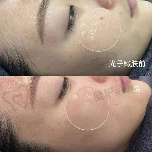 北京嘉禾蔡圣民光子嫩肤的成效能维持多久？