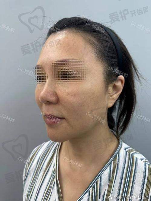 SMAS深筋膜线提升提升的价格是如何构成的？