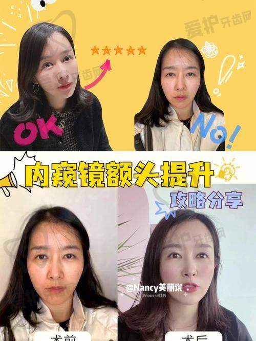 SMAS深筋膜线提升提升的成效能维持多久？