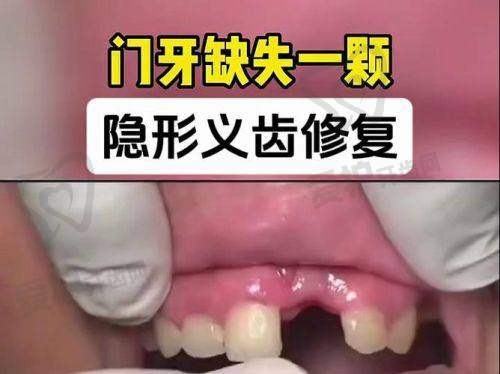 佩戴全口假牙需要注意什么？