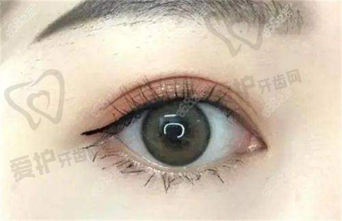 成都素美杨迪医生打造帕克双眼皮，仅需13700元起，美眼盛宴来袭！ 