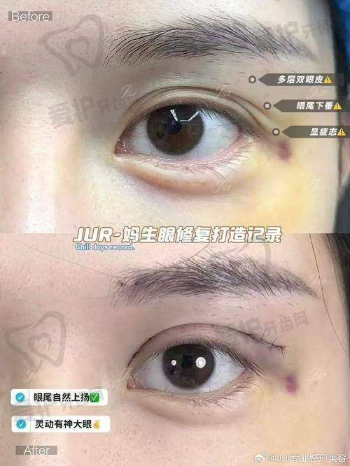 什么是帕克双眼皮？