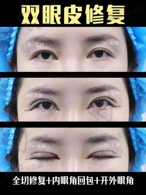 张化举医生：双眼皮修复领域的佼佼者是谁？