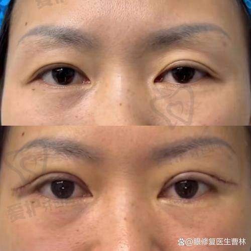 哈尔滨超龙整形医院张化举医生，双眼皮修复惊艳开启，20000元起焕美新生！ 