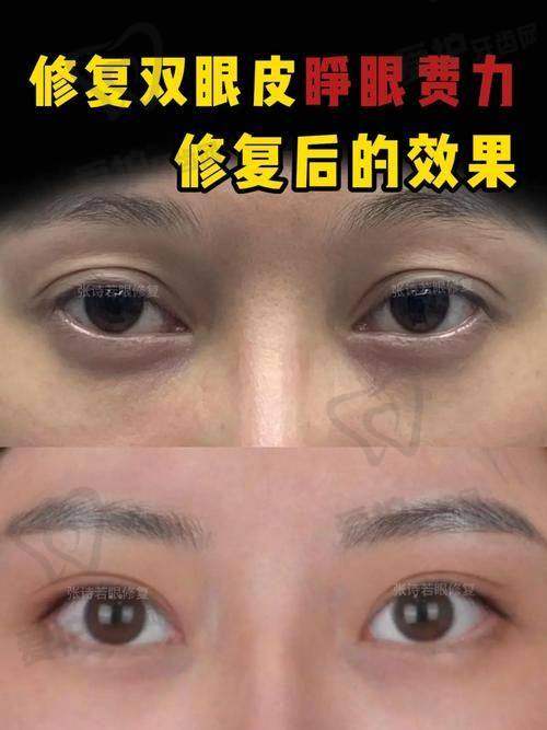 双眼皮修复20000元起，价格区间是怎样的？