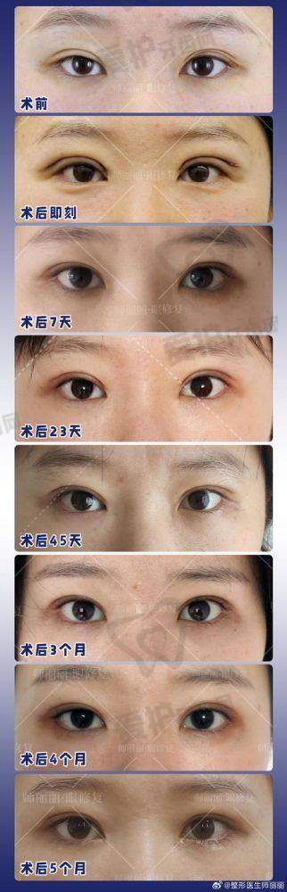 双眼皮修复有哪些注意事项？