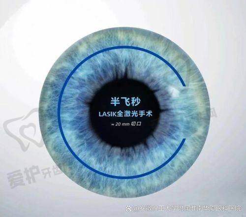 半飞秒近视手术有哪些注意事项？