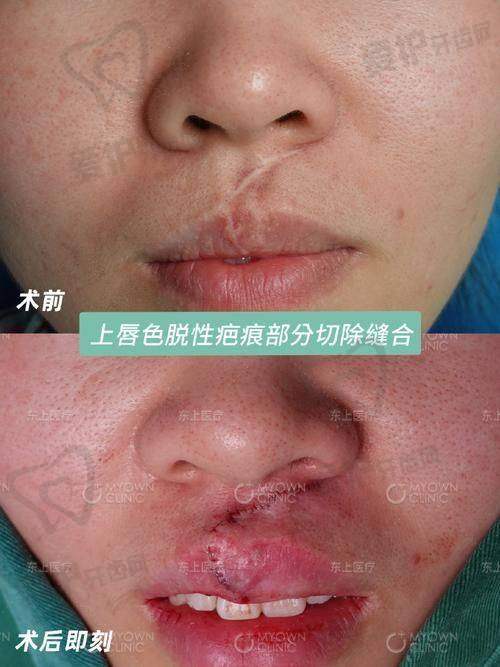 重庆华美紫馨整形医院疤痕修复项目为何仅3800元起？