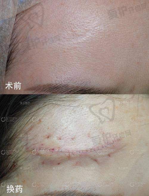 重庆华美紫馨整形医院疤痕修复技术有哪些优势？