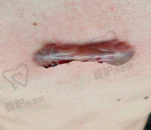 重庆华美紫馨整形医院与其他医院疤痕修复相比有何不同？