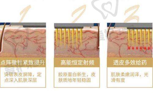 黄金微针和超声炮的功效对比如何？