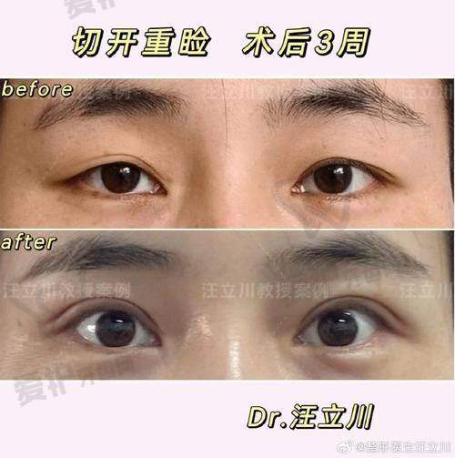 总结：成都纯曦林靖做双眼皮值得信赖吗？