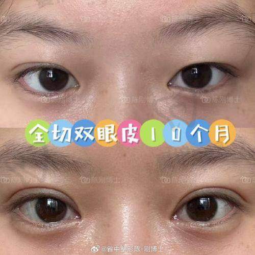 成都纯曦林靖医生做双眼皮的成效有保护吗？