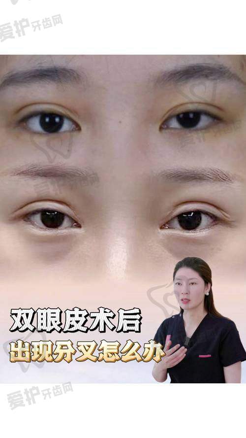 做双眼皮手术前需要做哪些准备？